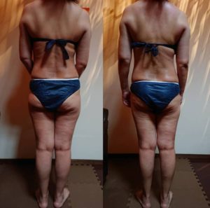 セルライトゼロ痩身