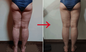 セルライトゼロ痩身