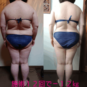 セルライトゼロ痩身